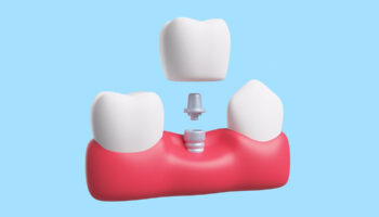 How Do I Prepare For Dental Implants?