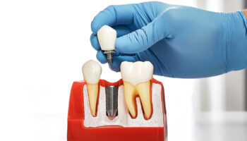 Tooth Extraction and Implant Timeline: Key Phases of the Process