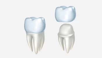 Common Mistakes to Avoid After a Same-Day Crown