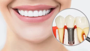How Dental Implants Improve Chewing, Speech, and Daily Comfort